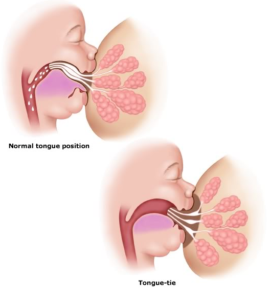 lip and tongue tie procedures | nashville tn dentist
