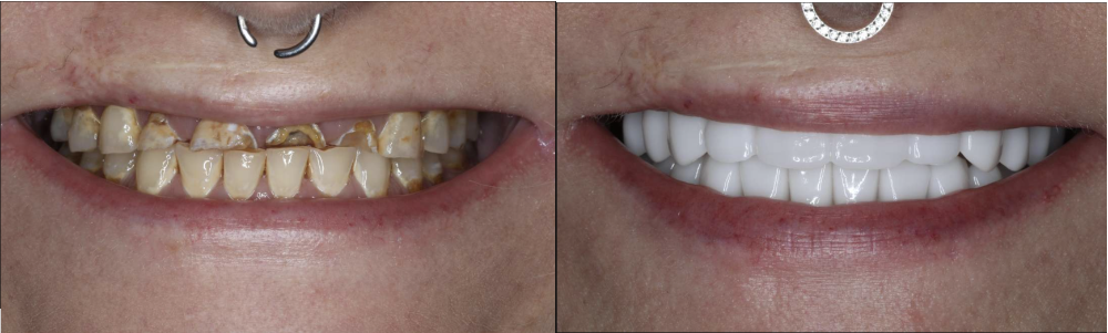 Before and after of full smile makeover, brentwood tn