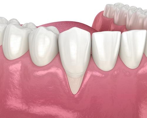 Image of teeth with gum disease, nashville tn