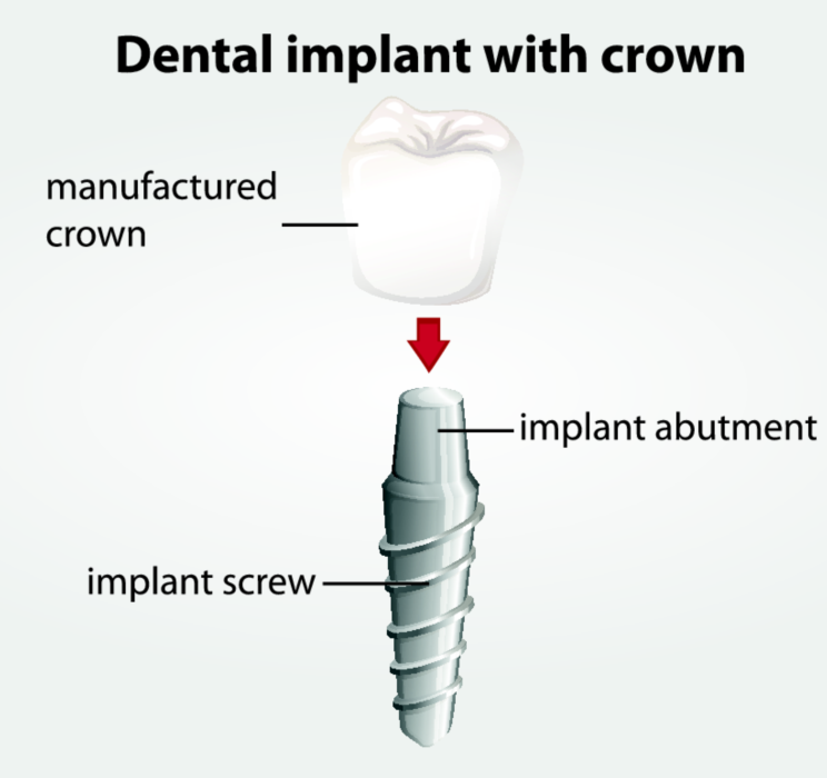 Dental Implant Diagram | Implants in Nashville TN