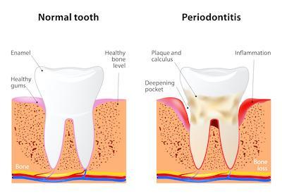 Diagram of tooth before and after periodontal disease, nashville tn