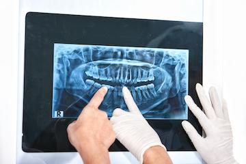 Digital X-Rays | Nashville TN Oral Surgery