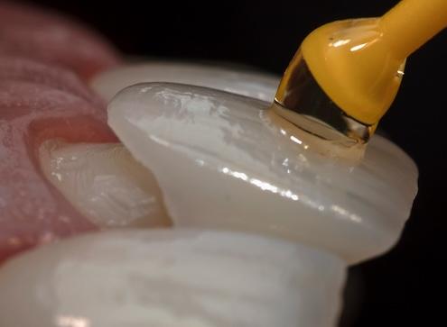 Image of veneer being put on a teeth, nashville tn