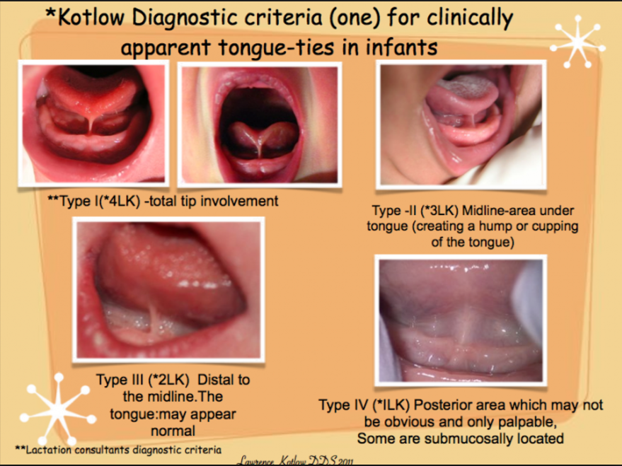 Tongue Tie Examples | Nashville TN