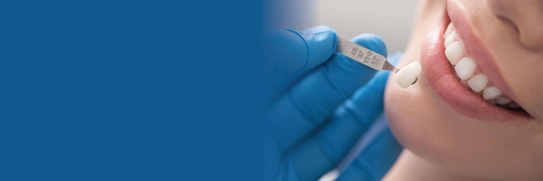 Getting porcelain veneers | dentist Brentwood