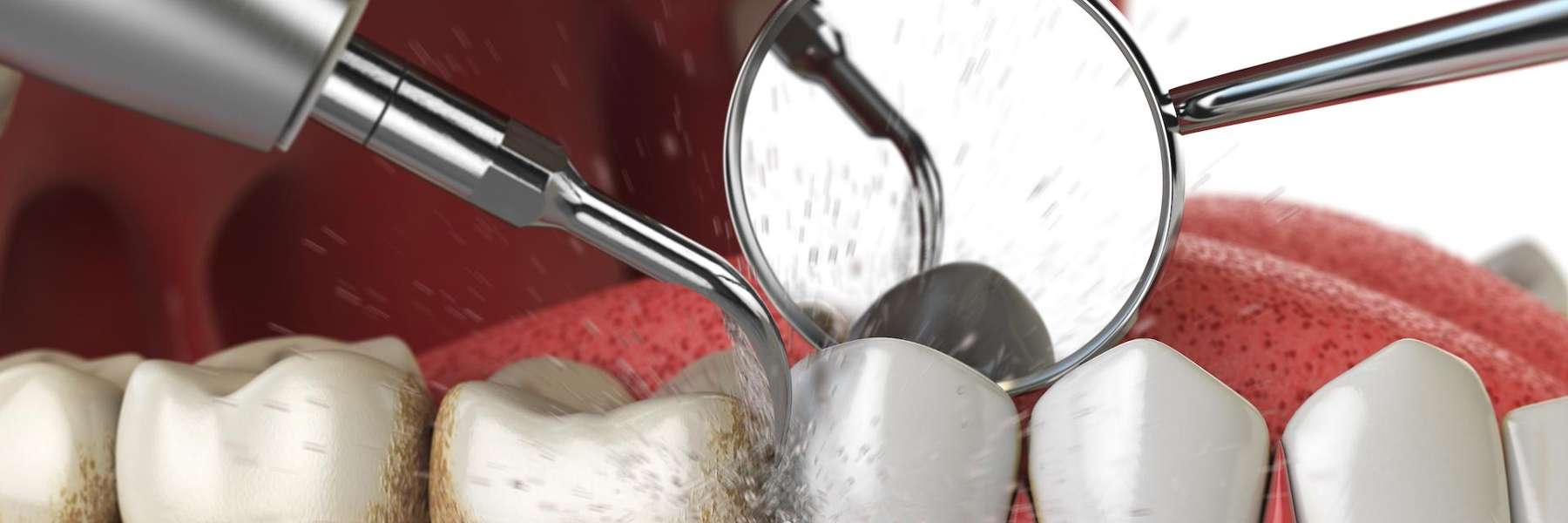 A diagram of a teeth cleaning in Brentwood TN