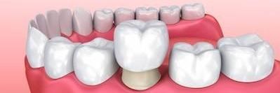 image of a dental crown in brentwood tn