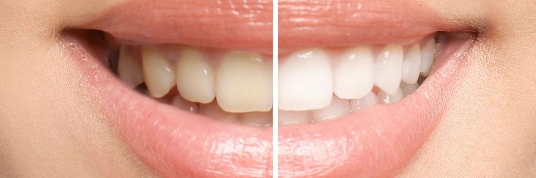 Before and after teeth whitening