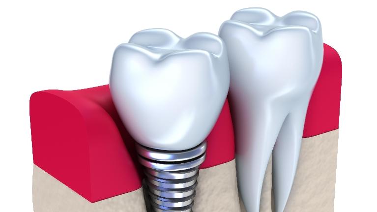 dental implant illustration | brentwood tn