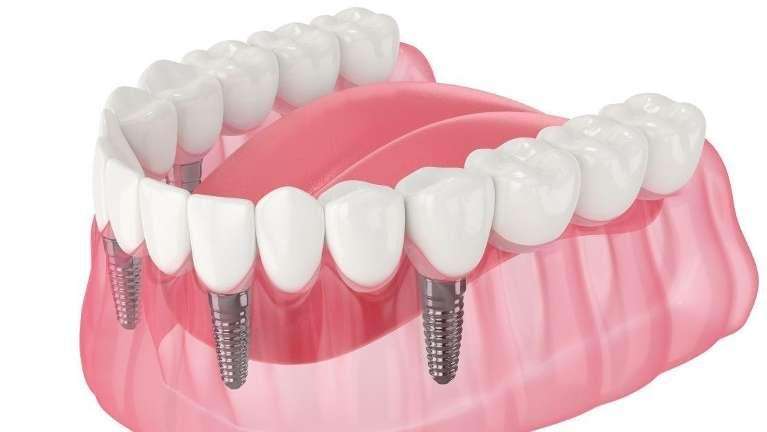 Diagram of a mouth with hybrid dental implants, brentwood tn