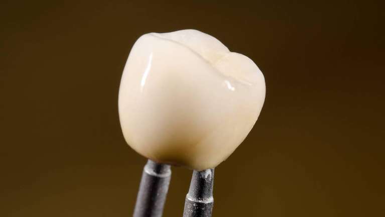image of a dental implant in brentwood tn