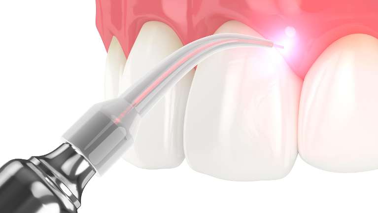 Laser periodontal treatment diagram