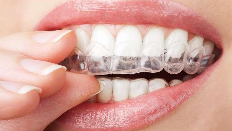 woman wearing clear braces in brentwood tn