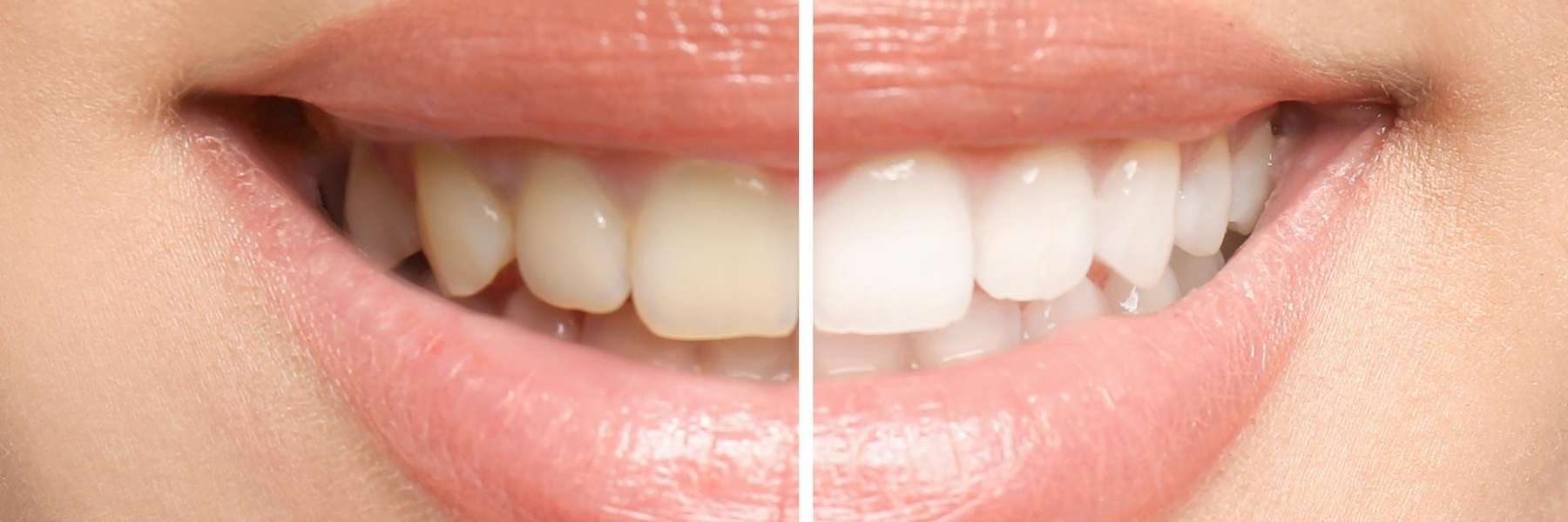 Womans smile before and after teeth whitening, brentwood tn