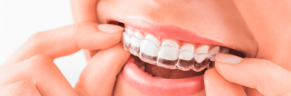 Woman putting invisalign clear aligner in her mouth, brentwood tn
