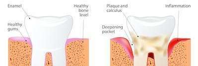 image of gum disease in Brentwood TN