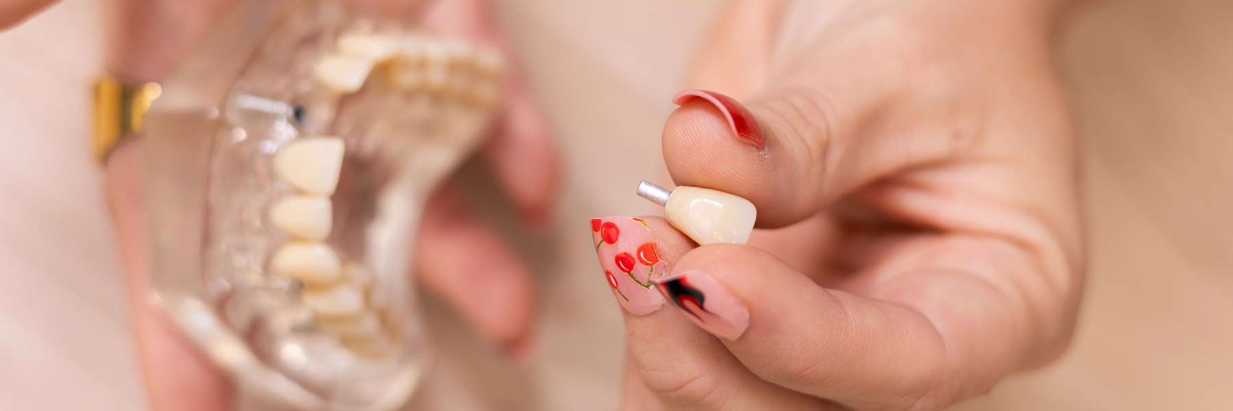 Individual Dental Implants | Dentist