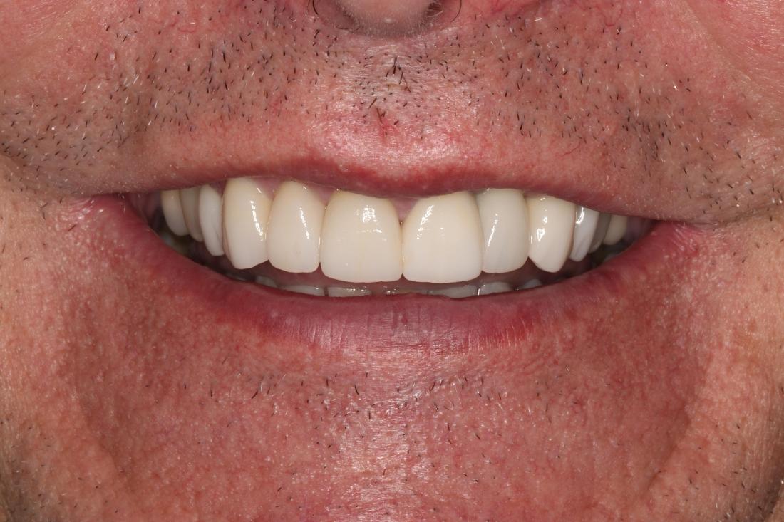 man smiling after veneers in nashville, tn