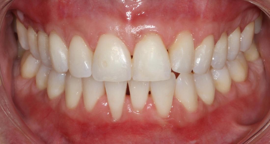 Pinhole grafting to correct severe recession | Sullivan Dental Partners