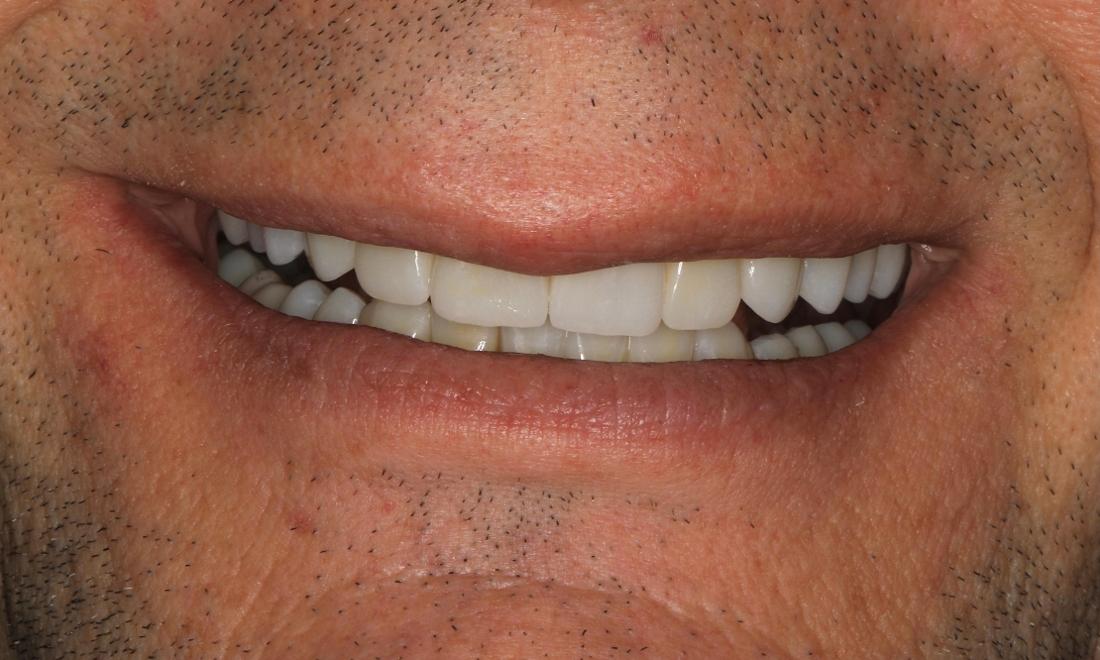 smile after full mouth rehab in brentwood