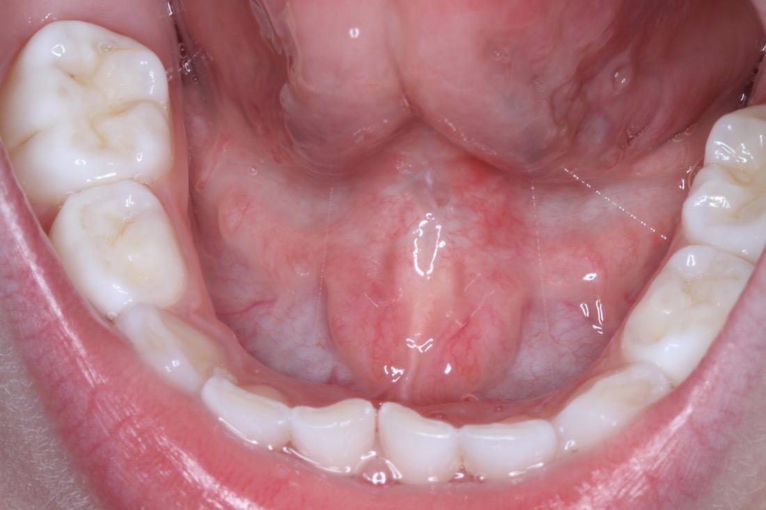 Lip and tongue tie treatment | Sullivan Dental Partners