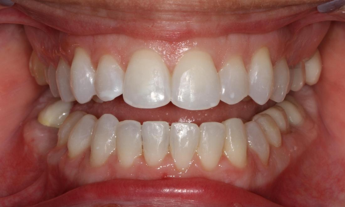 Six month smiles used to straighten teeth | Sullivan Dental Partners