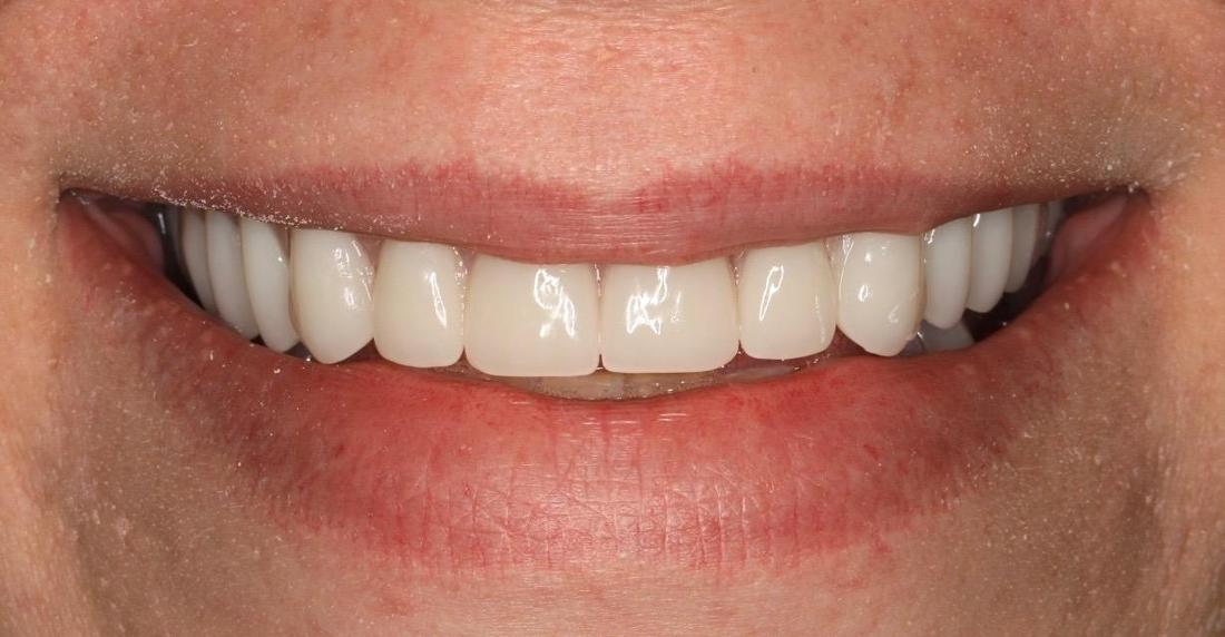 smile with dentures in nashville tn