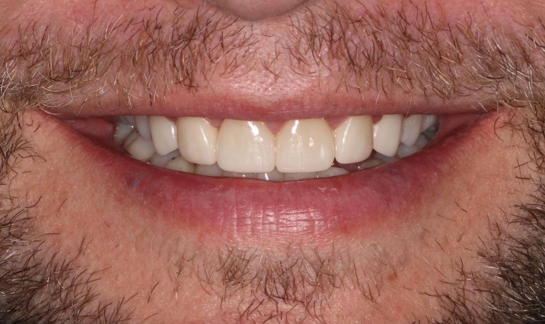 smile after upper veneers in brentwood tn