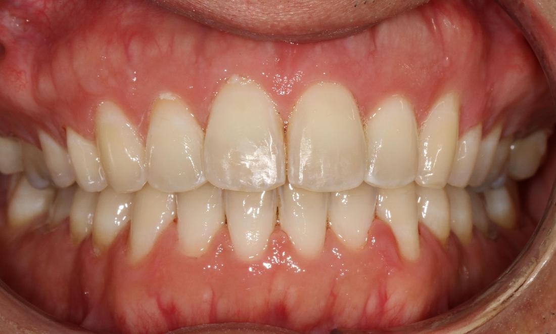 Six month smiles to straighten teeth | Dentist Brentwood TN