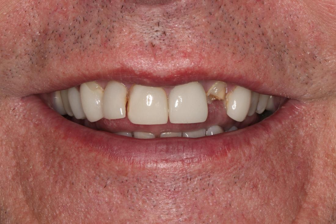 smile before veneers in nashville, tn