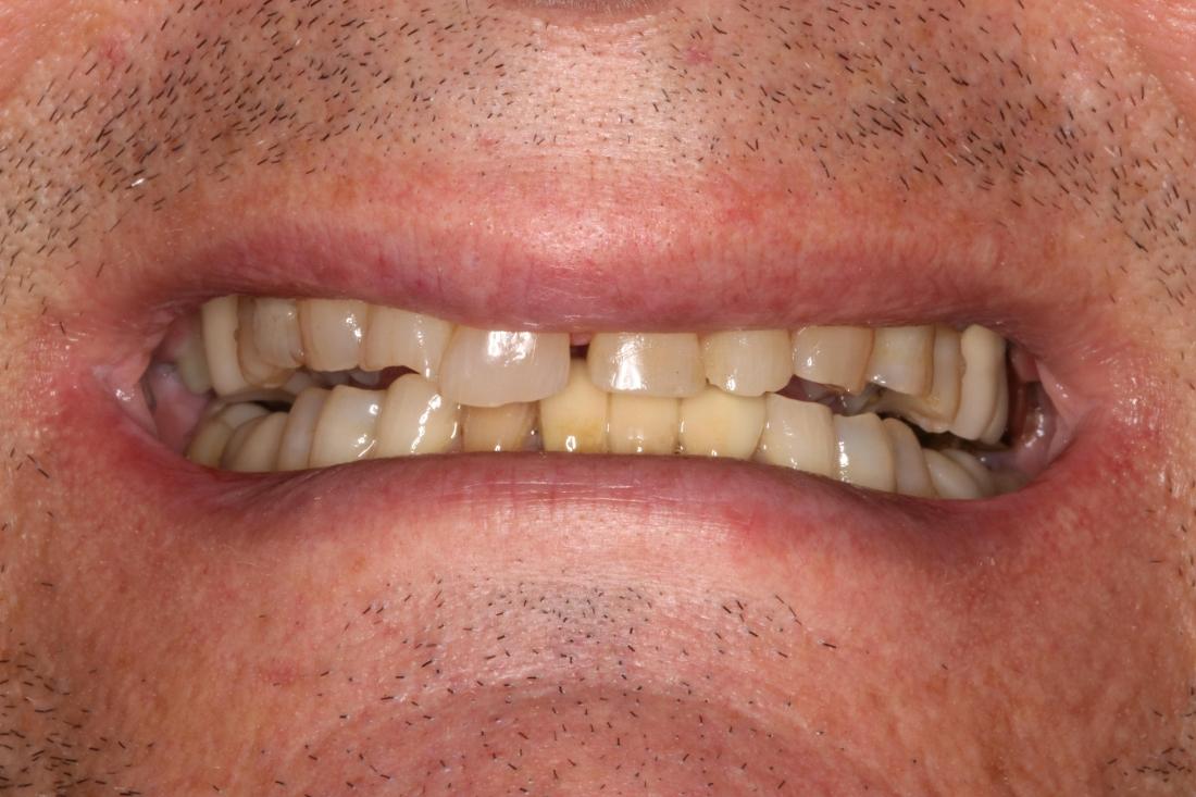 smile before full mouth rehab in brentwood