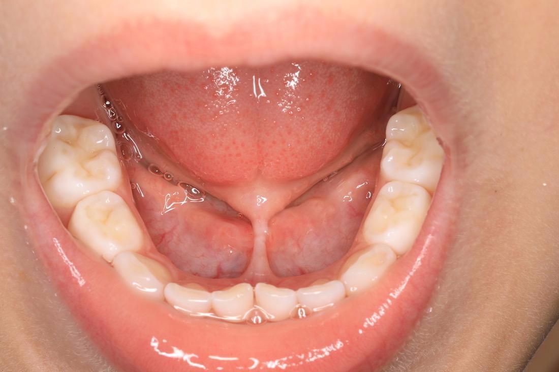 Lip and tongue tie | Sullivan Dental Partners