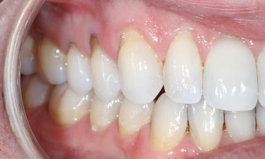 Upper right teeth with gum recession | Sullivan Dental Partners