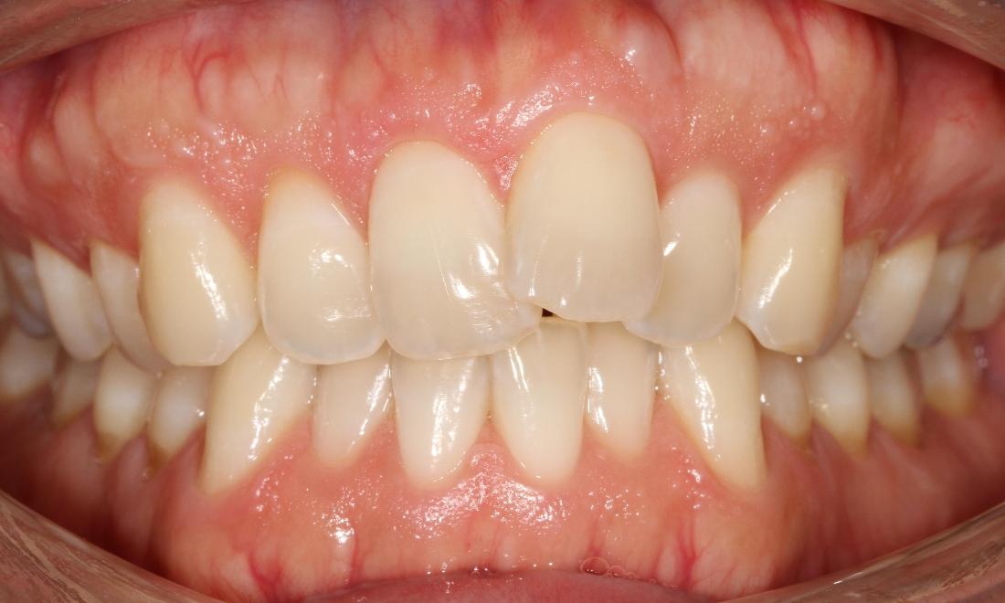 Crowded front teeth | Sullivan Dental Partners
