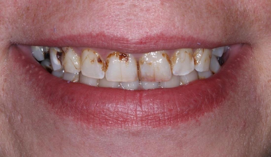 smile without upper dentures in nashville tn
