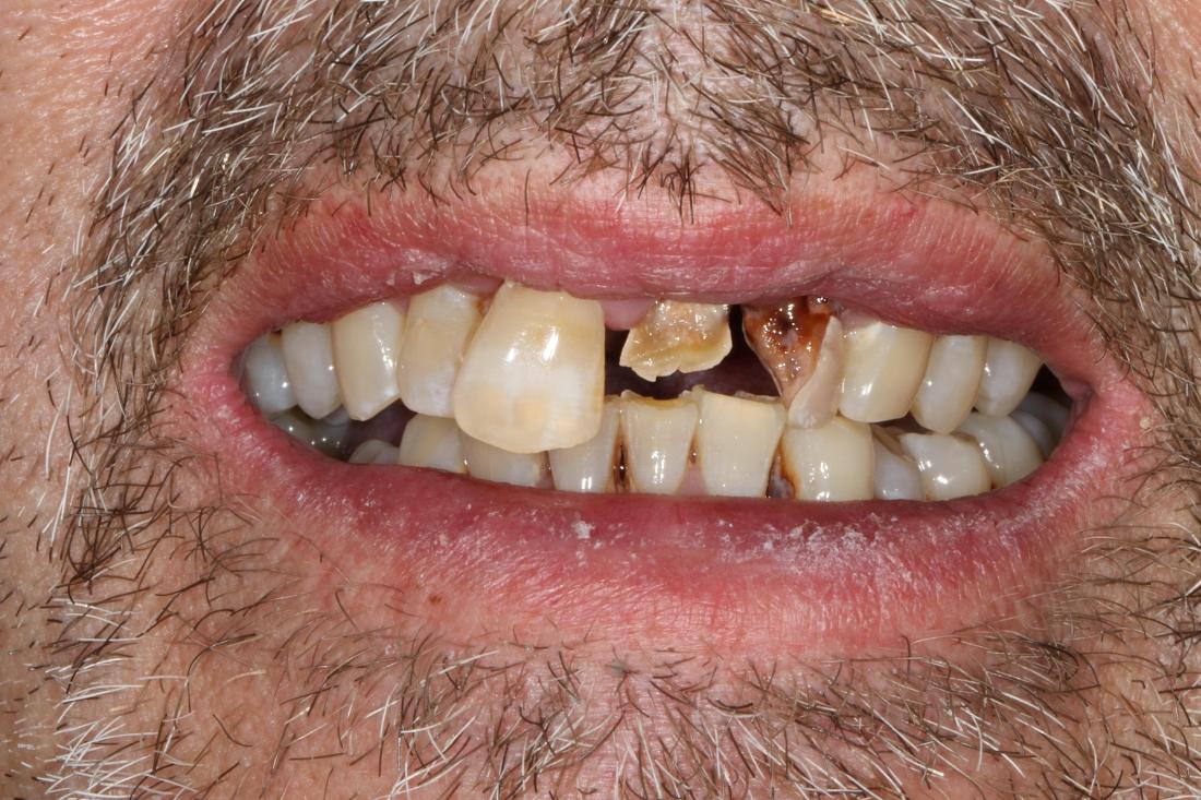 smile before locator denture in nashville tn