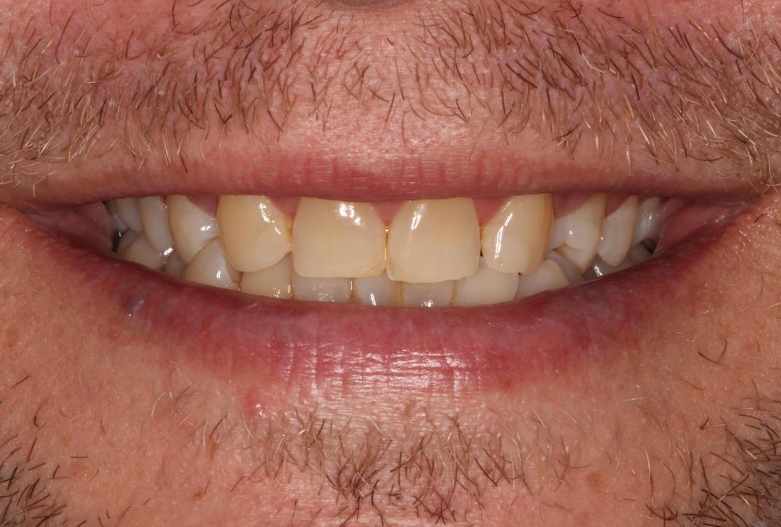 smile before upper veneers in brentwood tn