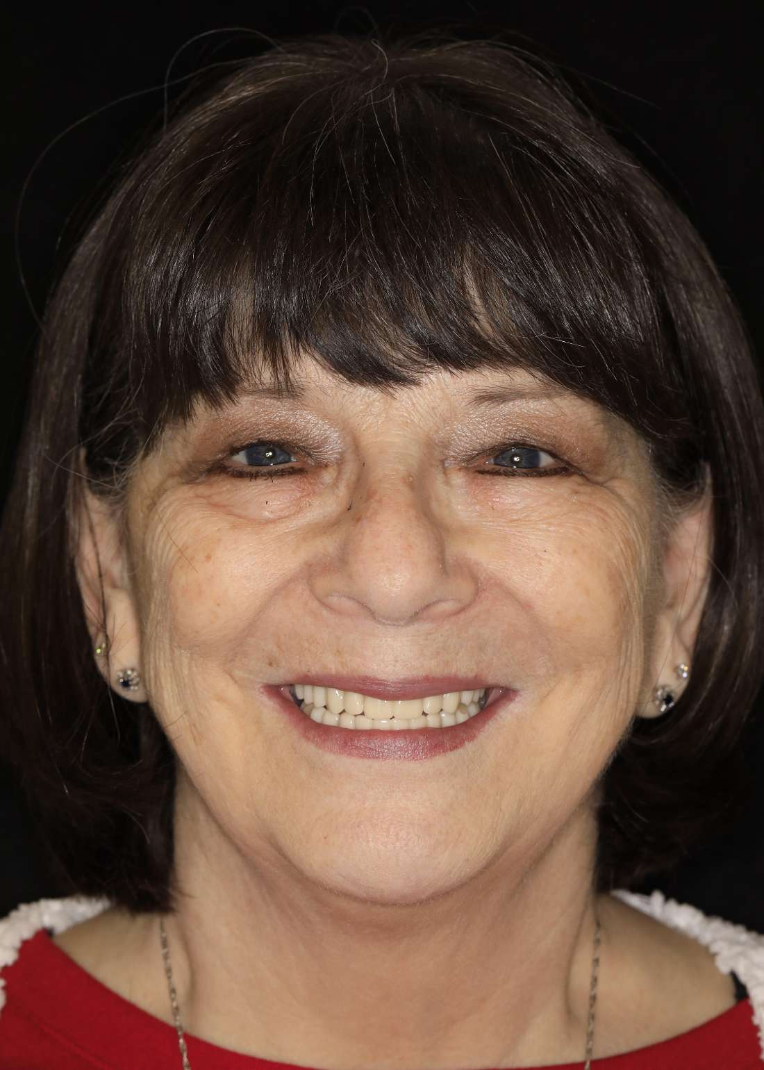 After all-on-x implants, brentwood tn