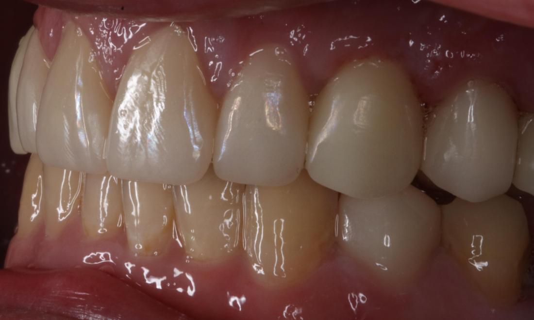 Close up of mouth from a side view after a complete smile makeover, nashville tn