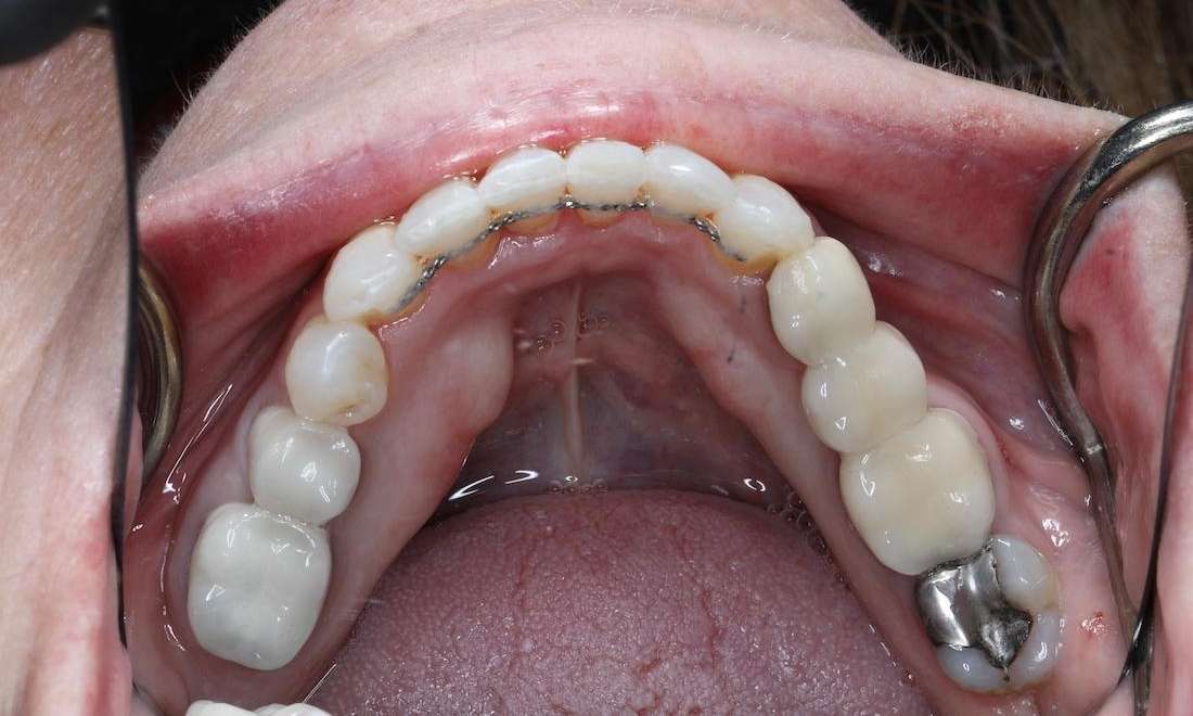 View of mouth wide open after cosmetic crowns and invisalign, brentwood tn