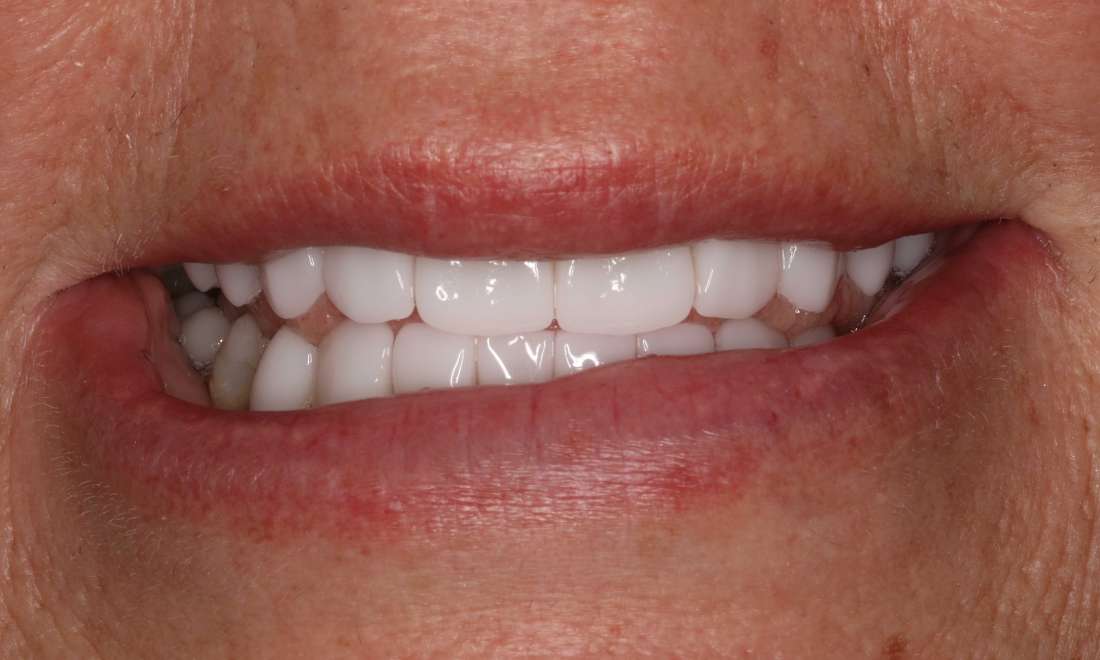 Patient teeth after cosmetic crowns Brentwood, TN