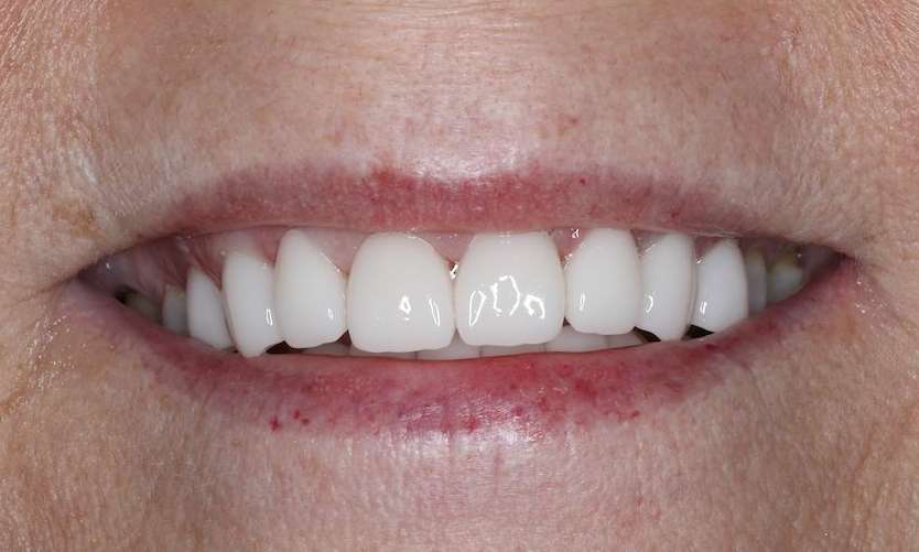 Close up of white womans mouth after cosmetic crowns, brentwood tn