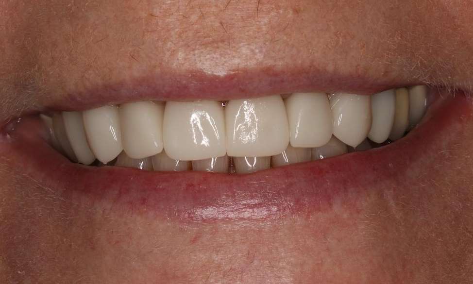 Close up of mouth after cosmetic crowns, brentwood tn