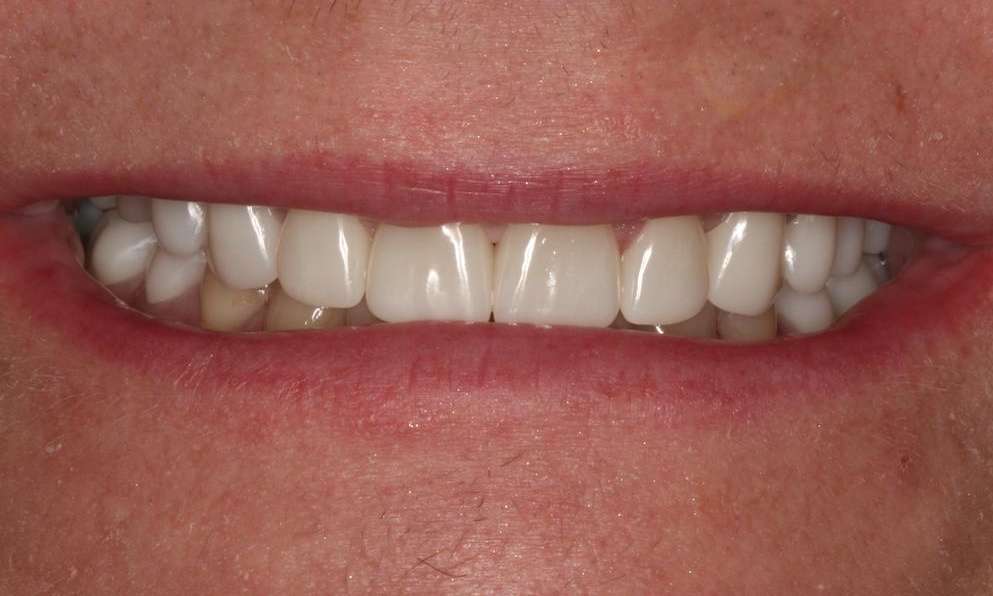 Mouth after cosmetic crowns, brentwood tn