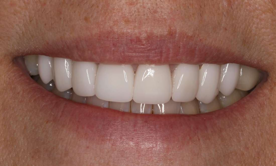 After cosmetic dentistry in Brentwood, TN