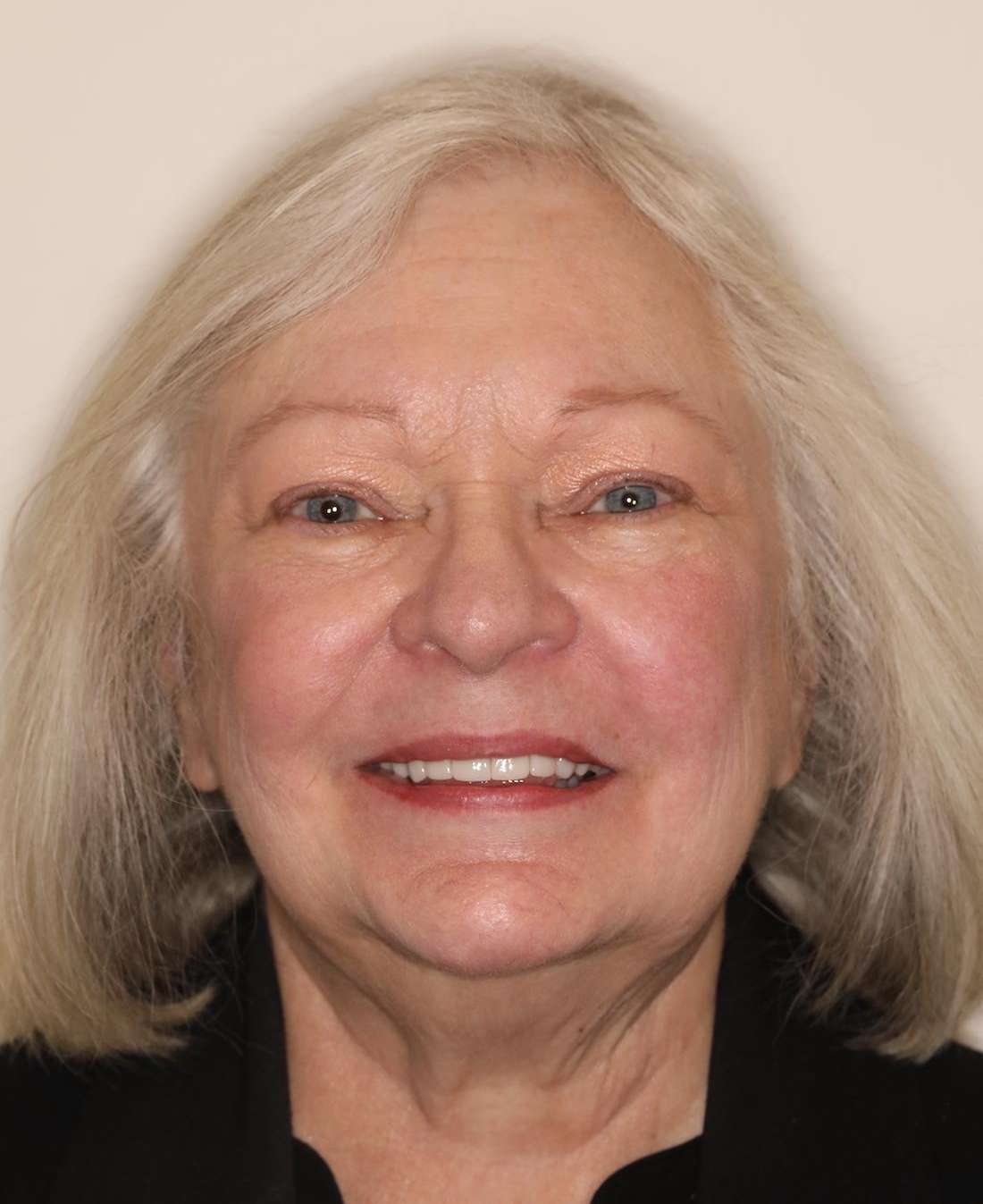 Older woman after CEREC cosmetic crowns, brentwood tn