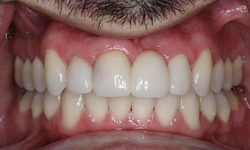Close up of mouth after dental bridge, brentwood tn