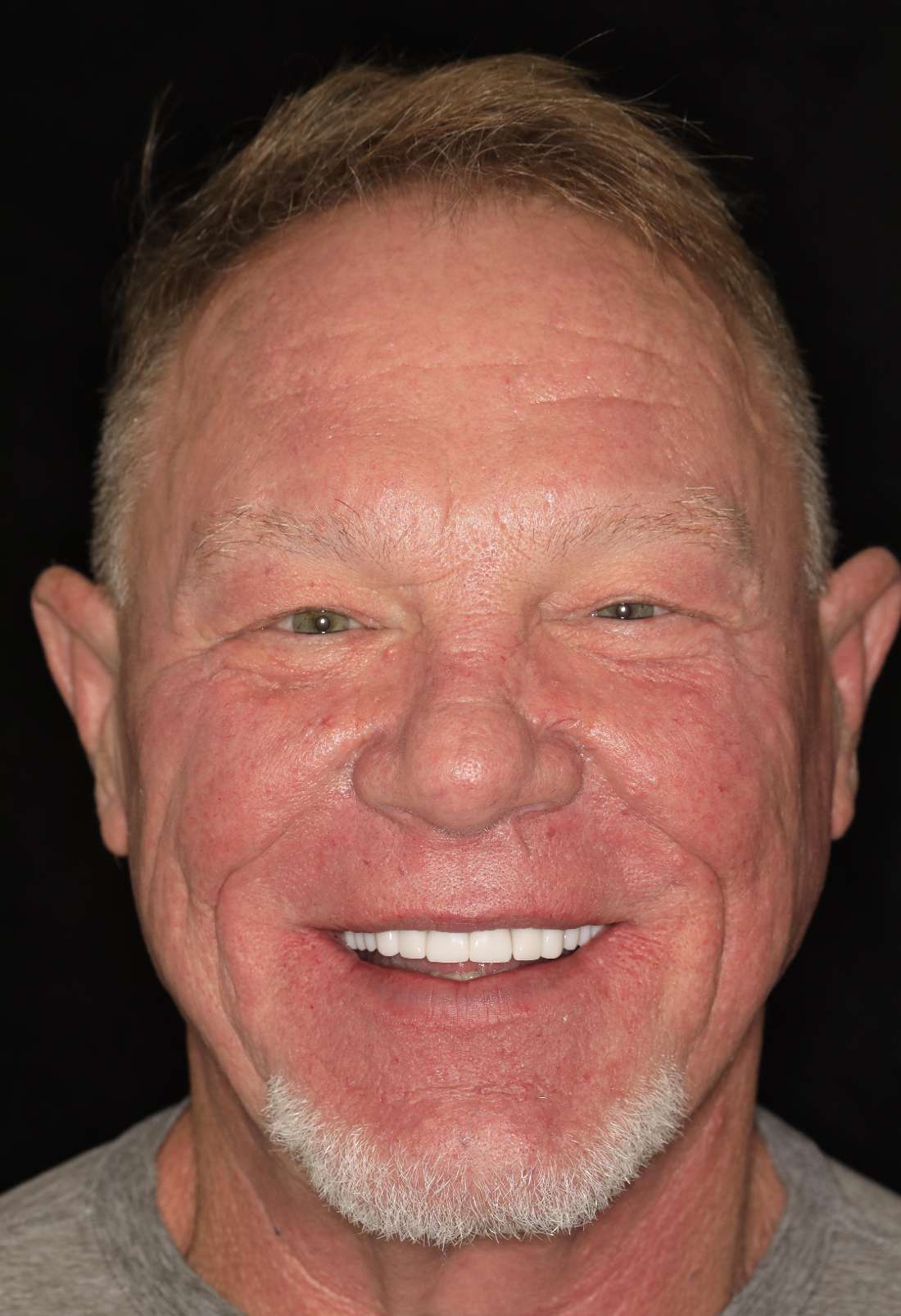 Man smiling after full smile makeover, nashville tn