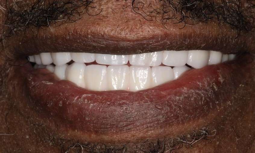 Close up view of black mans mouth after implant dentures, nashville tn