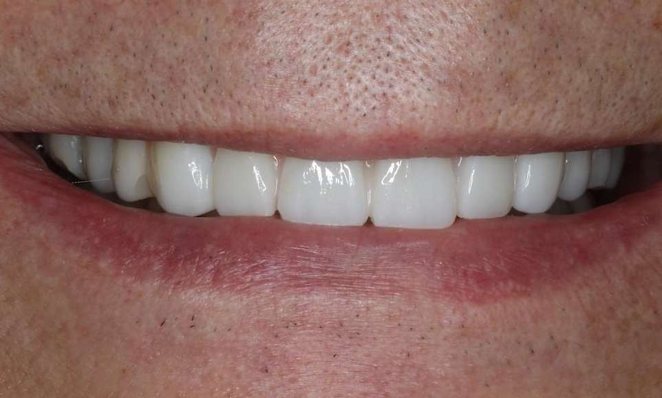 Mouth after implant dentures, nashville tn